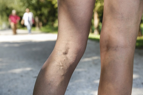 Painful varicose and spider veins on womans legs, who is active and working out, self-helping herself in overcoming the pain. Two active seniors in the background. Vascular disease, varicose veins problems, active life concept.